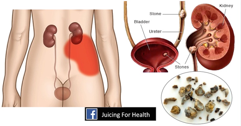 kidney rocks symptoms