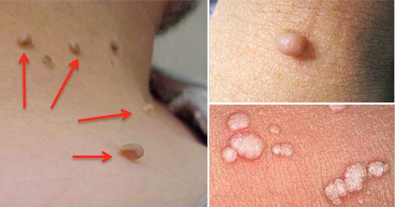 Remove Warts And Skin Tags Painlessly Without Bleeding