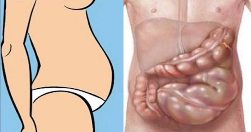 remedy-for-bloated-stomach-causes-and-remedies-you-can-try