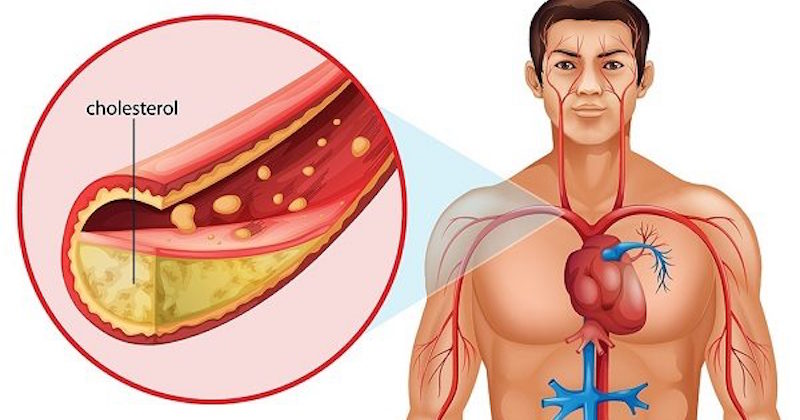 cholesterol not the problem