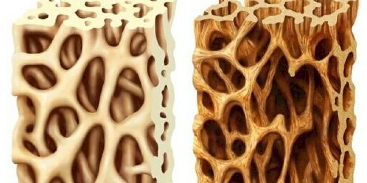 Osteoporosis: It’s Time You Check The Skeletons In The Closet