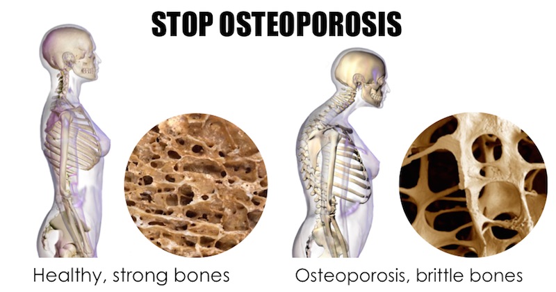 stop osteoporosis