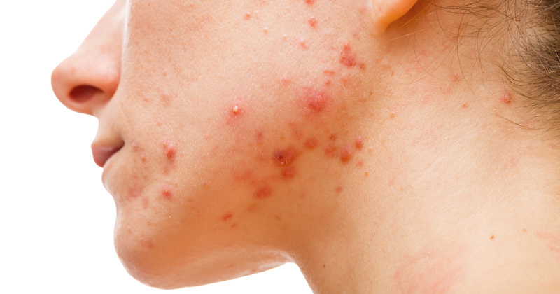 how to get rid of acne naturally