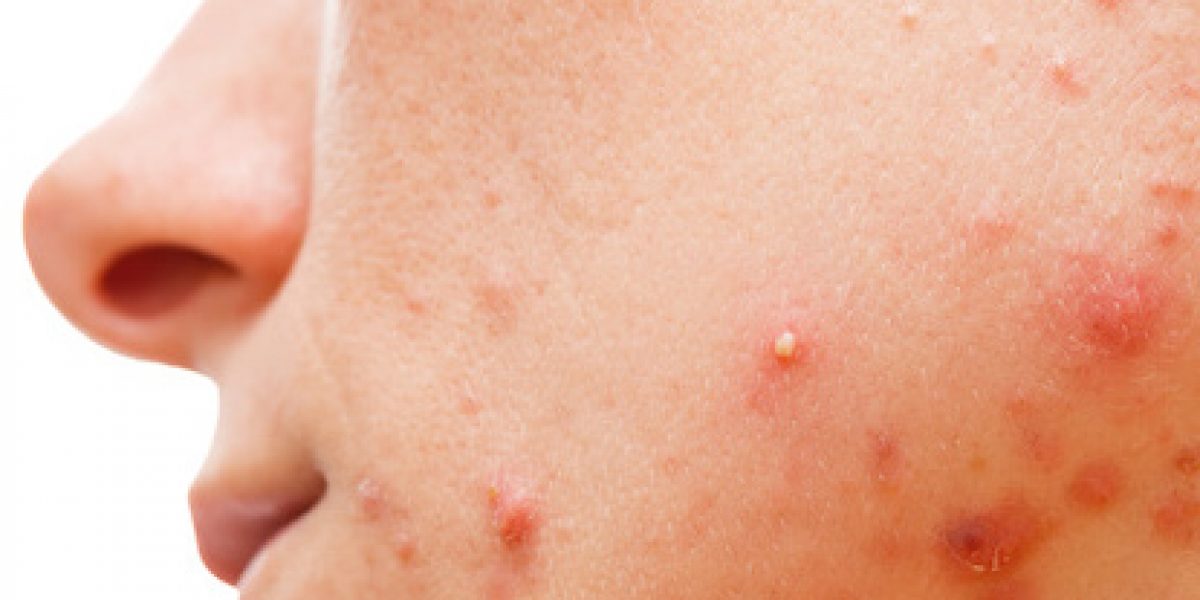 10 Home Remedies To Eliminate Acne And Pimples That Are Effective