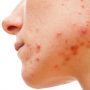10 Home Remedies To Eliminate Acne And Pimples That Are Effective
