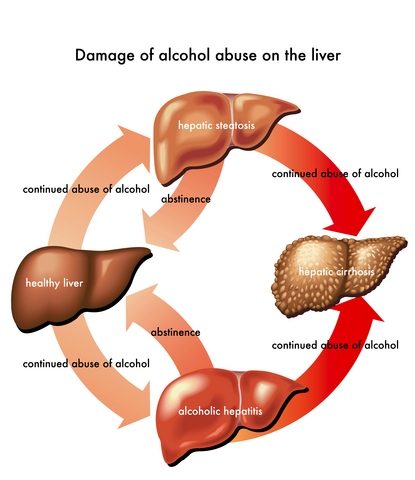 alcohol poisoning and long term effects