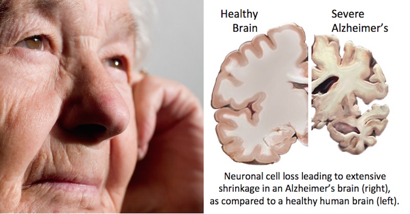 Alzheimer\u002639;s Disease May Be Prevented When You Know What 