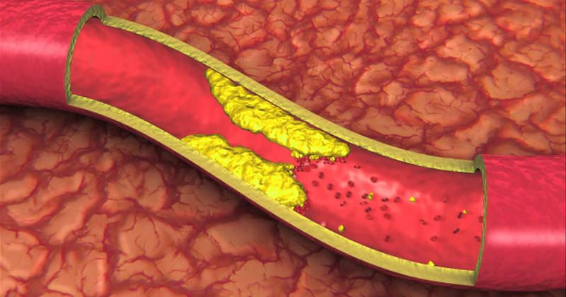 Natural remedies for reversing atherosclerosis