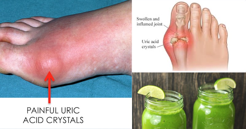 juices to remove uric acid crystalization