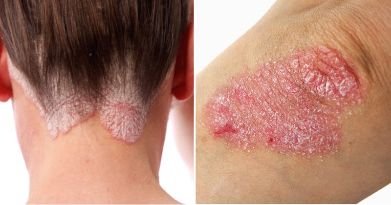 reverse psoriasis with diet