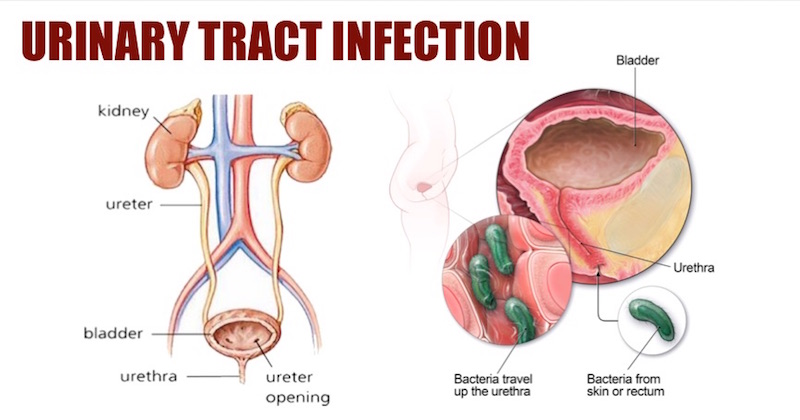 urinary tract infection