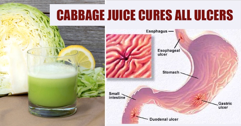 cabbage-juice-for-healing-stomach-ulcers-how-to-make-it