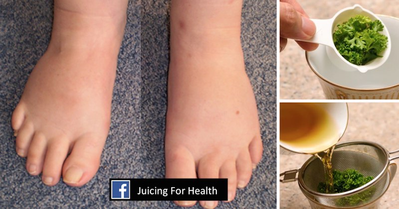 remedy swollen feet with parsley tea