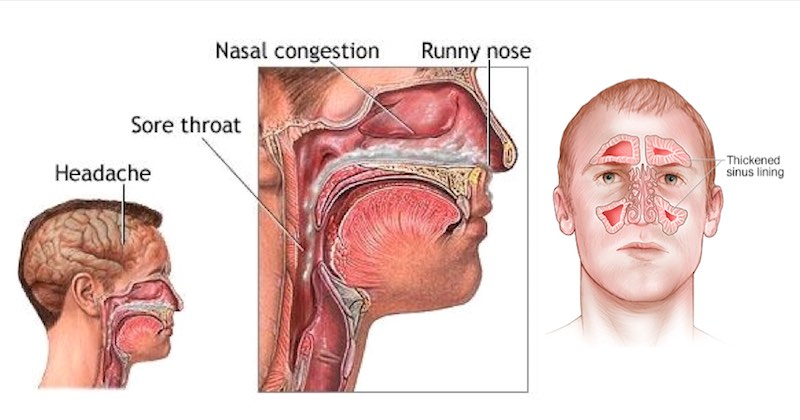 h press hydraulic Remedies Natural Infection Sinus Alleviate Sinus To  Ways