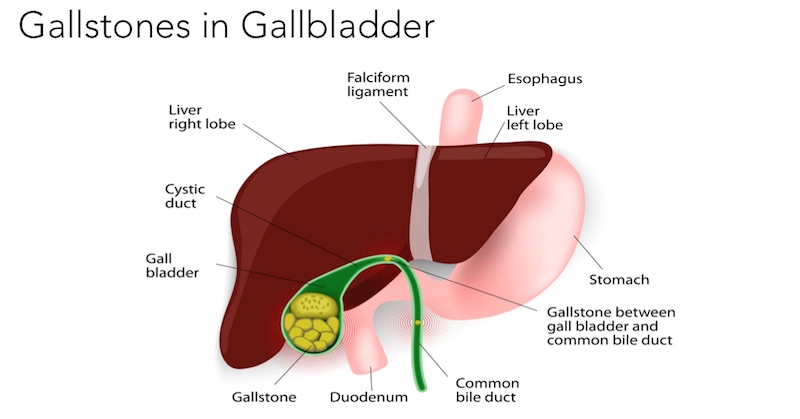 prevent gallstones formation