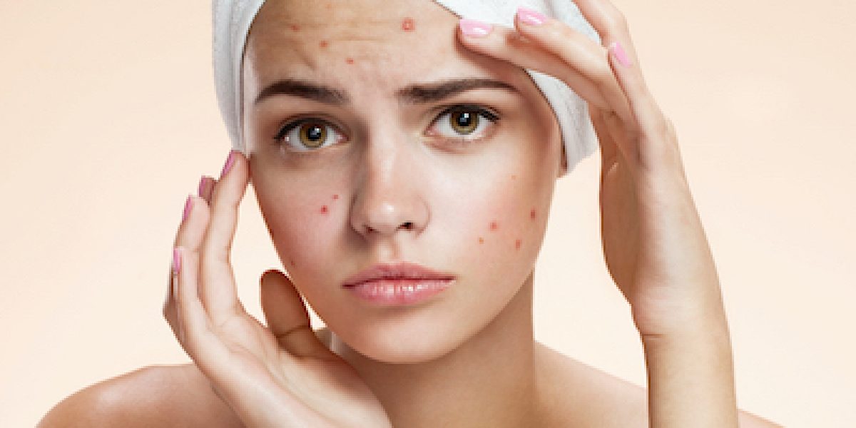 7 Acne Treatment Recipes That Have Absolutely No Harmful Chemicals