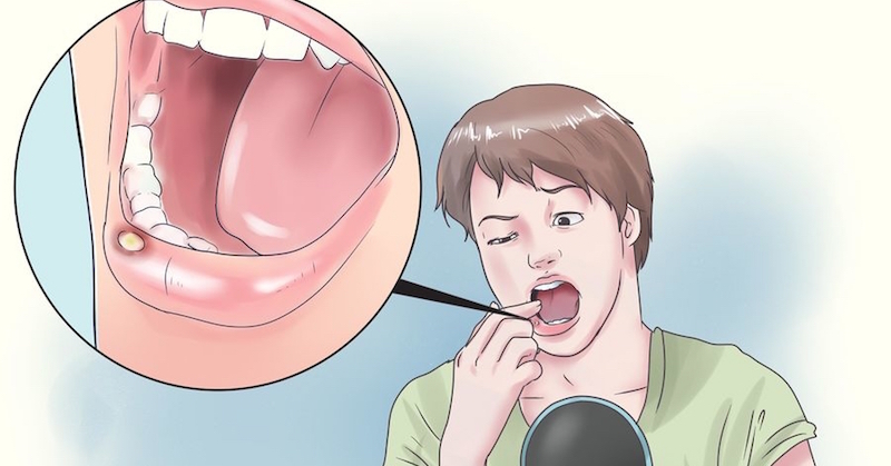 remedies for canker sores