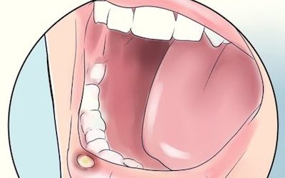 6 Natural Home Remedies To Ease And Treat Painful Canker Sores