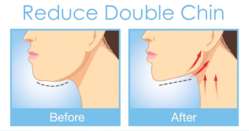 reduce double chin