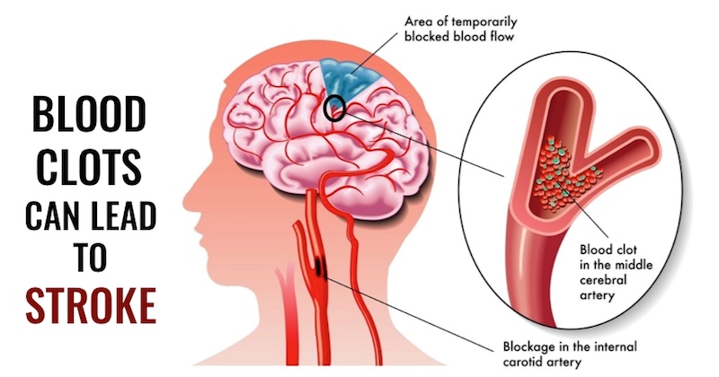 What Vegetables Reduce Blood Clots