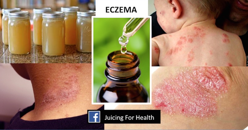 eczema remedies