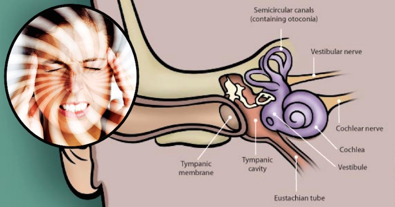 natural remedies for vertigo