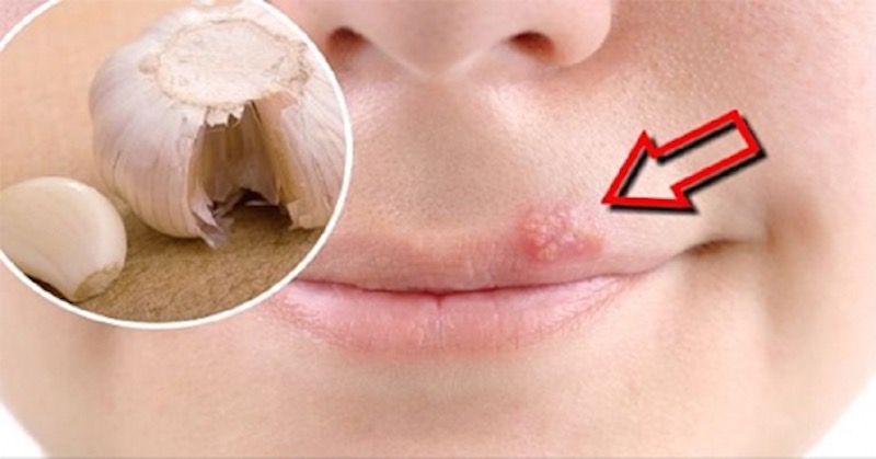 Relieve Herpes Outbreak With This Garlic Trick