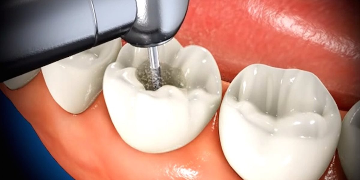 What Is Root Canal And How It Houses Dangerous, Toxin-Producing Organisms