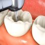 What Is Root Canal And How It Houses Dangerous, Toxin-Producing Organisms