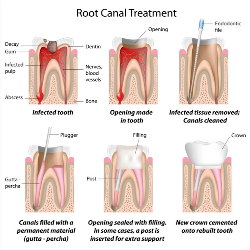 root canal is dangerous