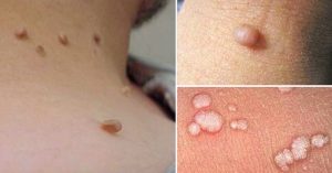 wart cancerous skin tags pictures