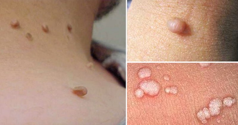 remove warts and skin tags painlessly without bleeding