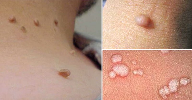 genital skin tags pregnancy