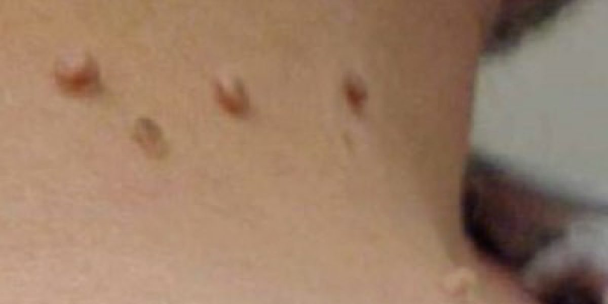 Remove Skin Tags, Corns, Warts Without Scarring, Bleeding Or Pain