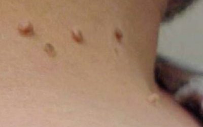 Remove Skin Tags, Corns, Warts Without Scarring, Bleeding Or Pain