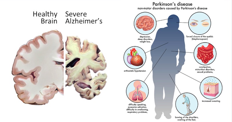 Что лучше паркинсон или альцгеймер