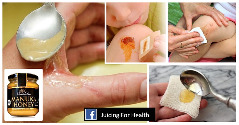 manuka honey treat wounds