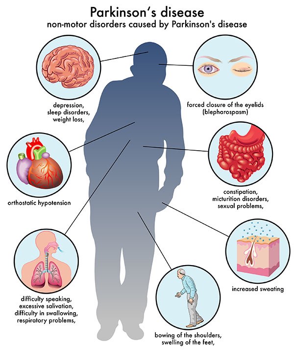 reverse parkinson's disease