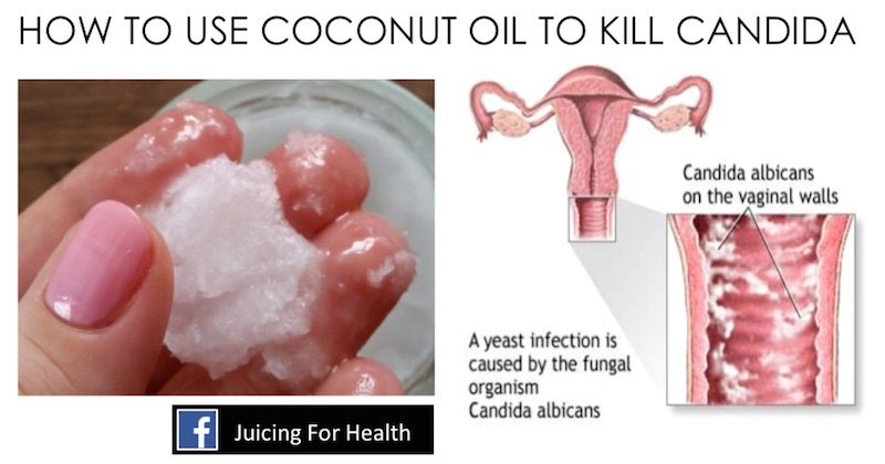 coconut oil reverse yeast infections