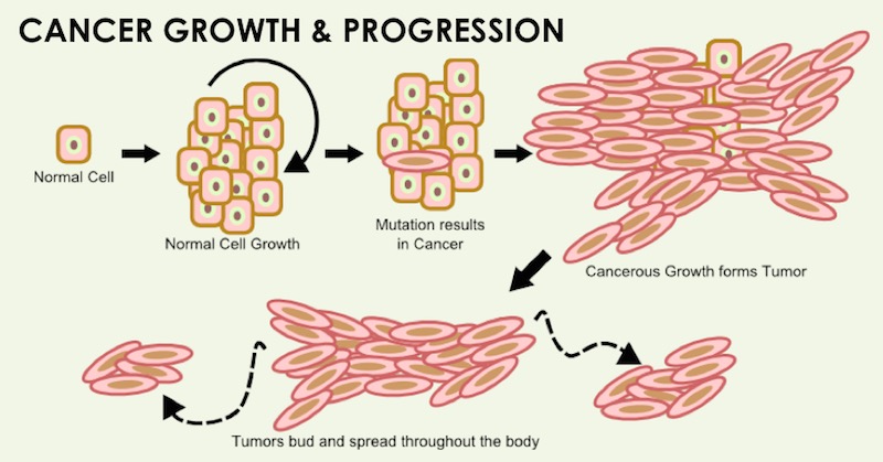 Cancer growth progression