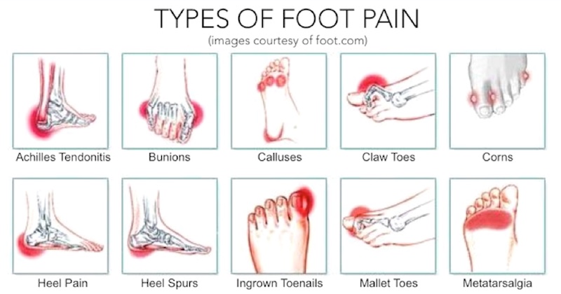 [diagram] Diagram Foot Pain Locations Mydiagram Online