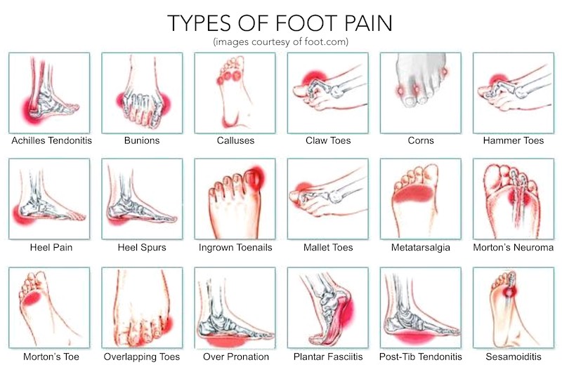 types of foot pain