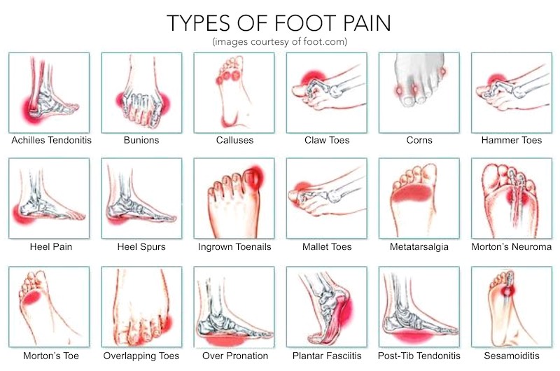 Identifying Foot Pain Types