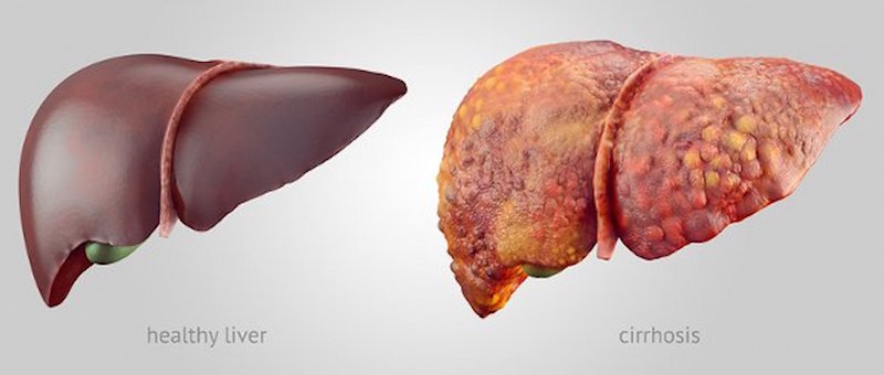 chronic liver disease symptoms