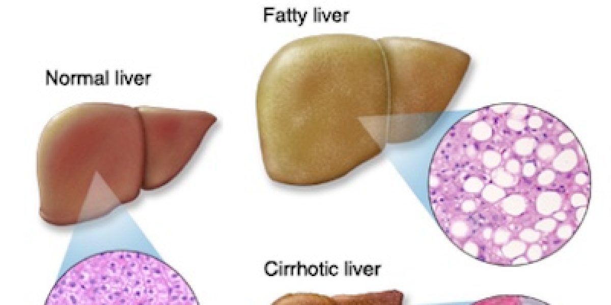 Fatty Liver Disease: What Is It, Are You At Risk, Causes, And How To Lower Your Risk