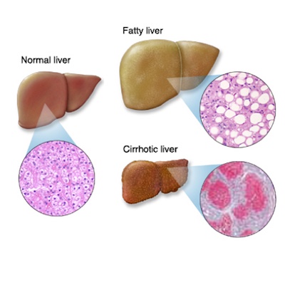 Fatty Liver Causes And Risks. Importance of knowing the risk factors.