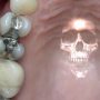 Why You Need A Mercury-Safe Dentist To Safely Remove Your Mercury Dental Filling