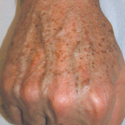 brown-spotted hand