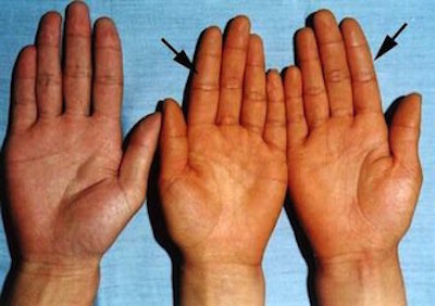 carotenemia hands