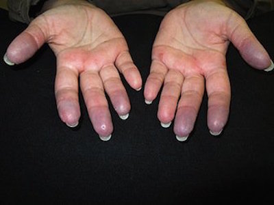 raynaud syndrome